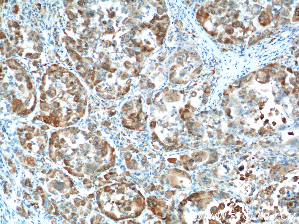 Immunohistochemistry (IHC) staining of human liver cancer tissue using Glutamine Synthetase Monoclonal antibody (66323-1-Ig)