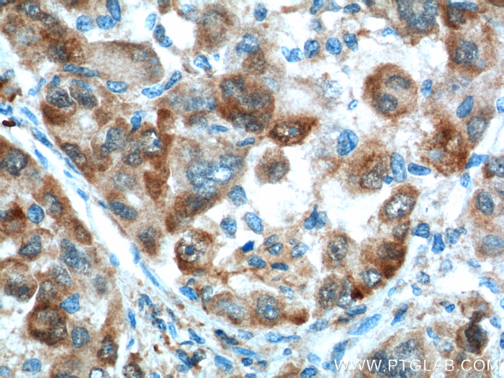 Immunohistochemistry (IHC) staining of human liver cancer tissue using Glutamine Synthetase Monoclonal antibody (66323-1-Ig)