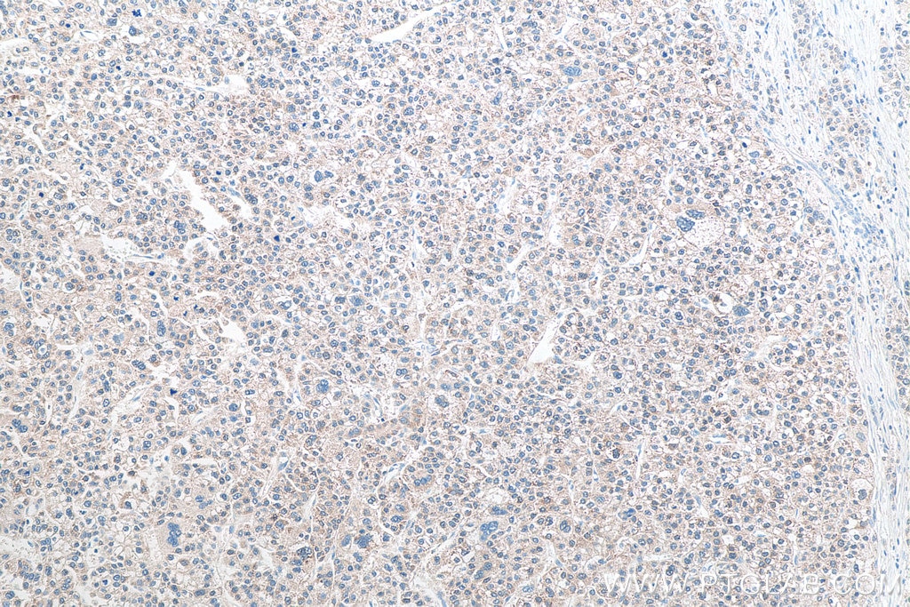 Immunohistochemistry (IHC) staining of human liver cancer tissue using Glutamine Synthetase Monoclonal antibody (66323-2-Ig)