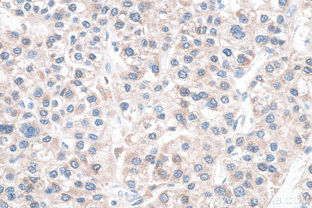 Immunohistochemistry (IHC) staining of human liver cancer tissue using Glutamine Synthetase Monoclonal antibody (66323-2-Ig)