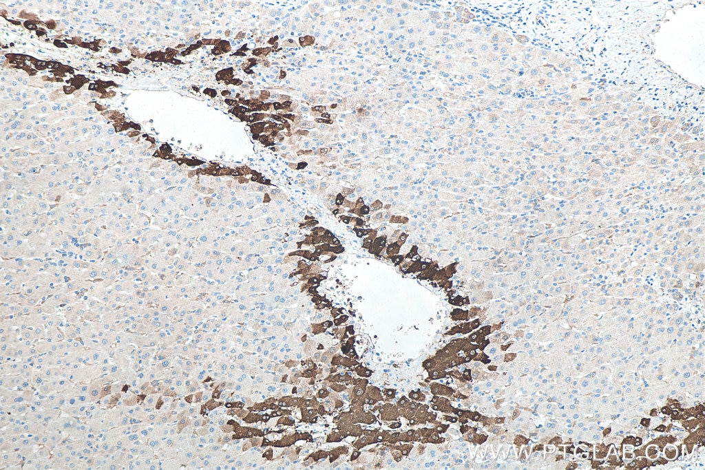 IHC staining of human liver cancer using 66323-2-Ig