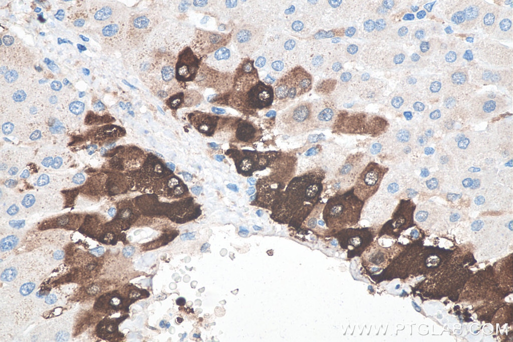 Immunohistochemistry (IHC) staining of human liver cancer tissue using Glutamine Synthetase Monoclonal antibody (66323-2-Ig)