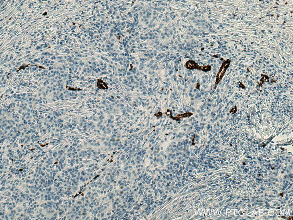 Immunohistochemistry (IHC) staining of human stomach cancer tissue using Glycophorin A  Monoclonal antibody (66778-1-Ig)