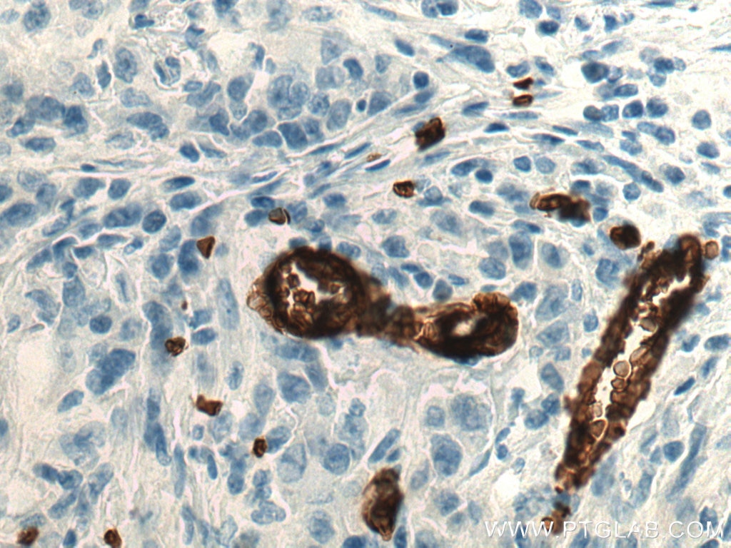 Immunohistochemistry (IHC) staining of human stomach cancer tissue using Glycophorin A  Monoclonal antibody (66778-1-Ig)