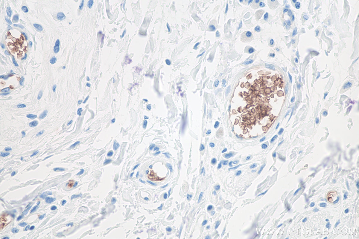 IHC staining of human colon cancer using 66778-1-Ig Immunohistochemistry (IHC) staining of human colon cancer tissue using Glycophorin A/CD235a Monoclonal antibody (66778-1-Ig)