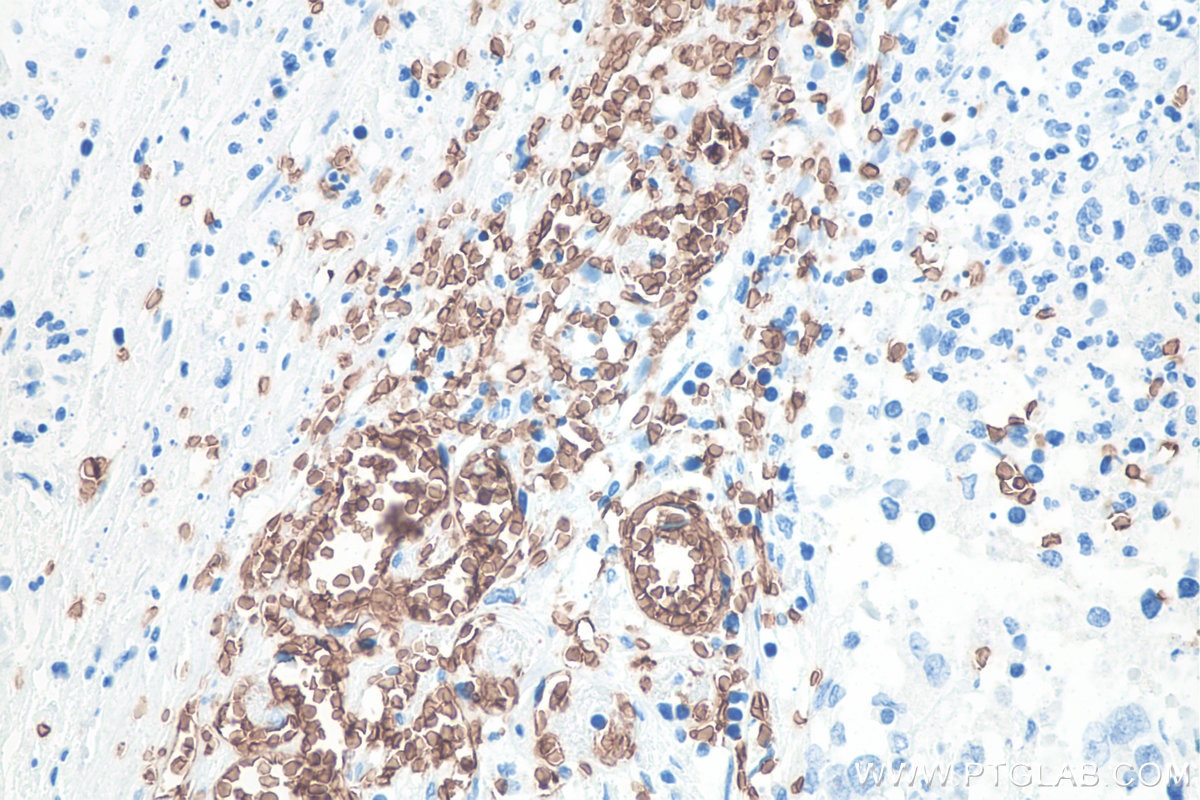 IHC staining of human stomach cancer using 66778-1-Ig Immunohistochemistry (IHC) staining of human stomach cancer tissue using Glycophorin A/CD235a Monoclonal antibody (66778-1-Ig)