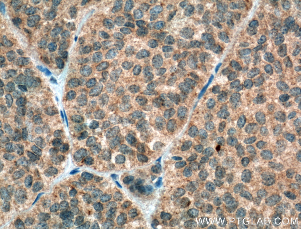 Immunohistochemistry (IHC) staining of human pituitary adenoma tissue using GH1 Polyclonal antibody (27079-1-AP)