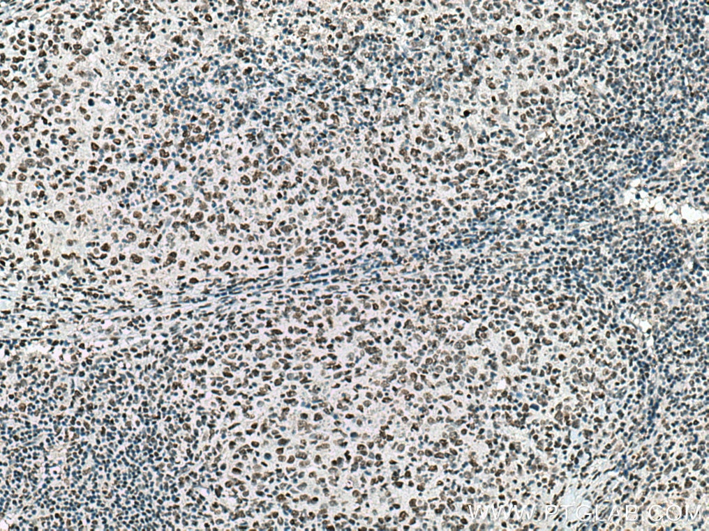 Immunohistochemistry (IHC) staining of human lymphoma tissue using Histone H2A.X Polyclonal antibody (10856-1-AP)