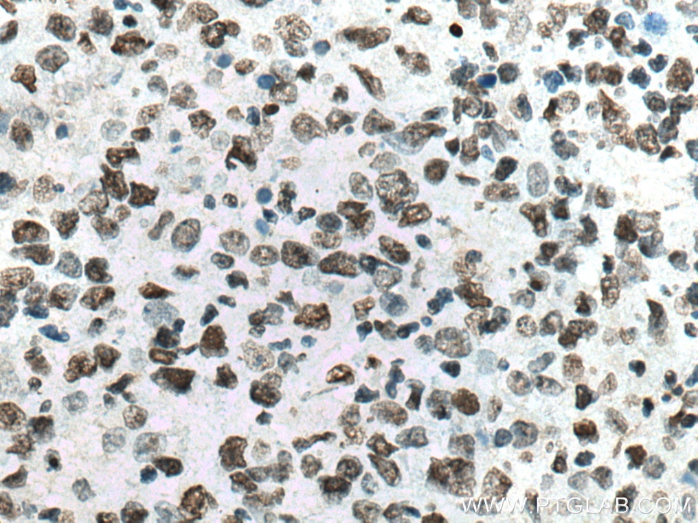 Immunohistochemistry (IHC) staining of human lymphoma tissue using Histone H2A.X Polyclonal antibody (10856-1-AP)