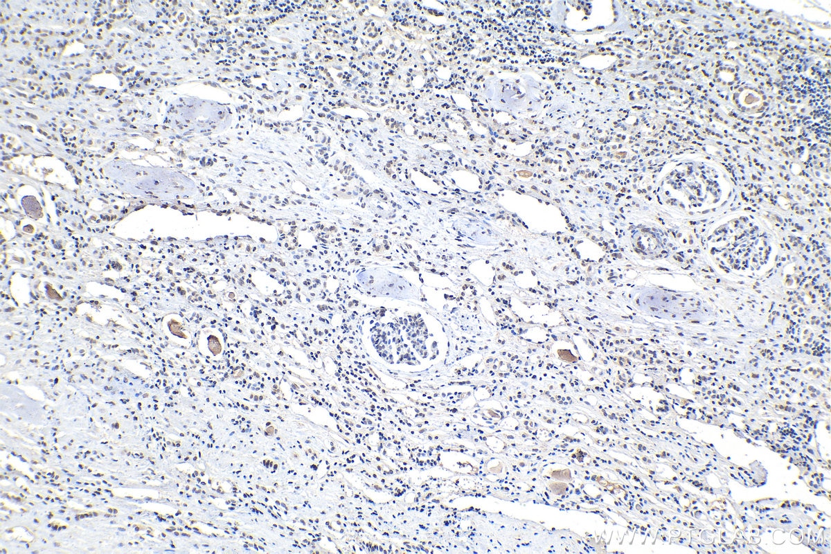 Immunohistochemistry (IHC) staining of human renal cell carcinoma tissue using Phospho-Histone H3 (Ser10) Monoclonal antibody (66863-1-Ig)