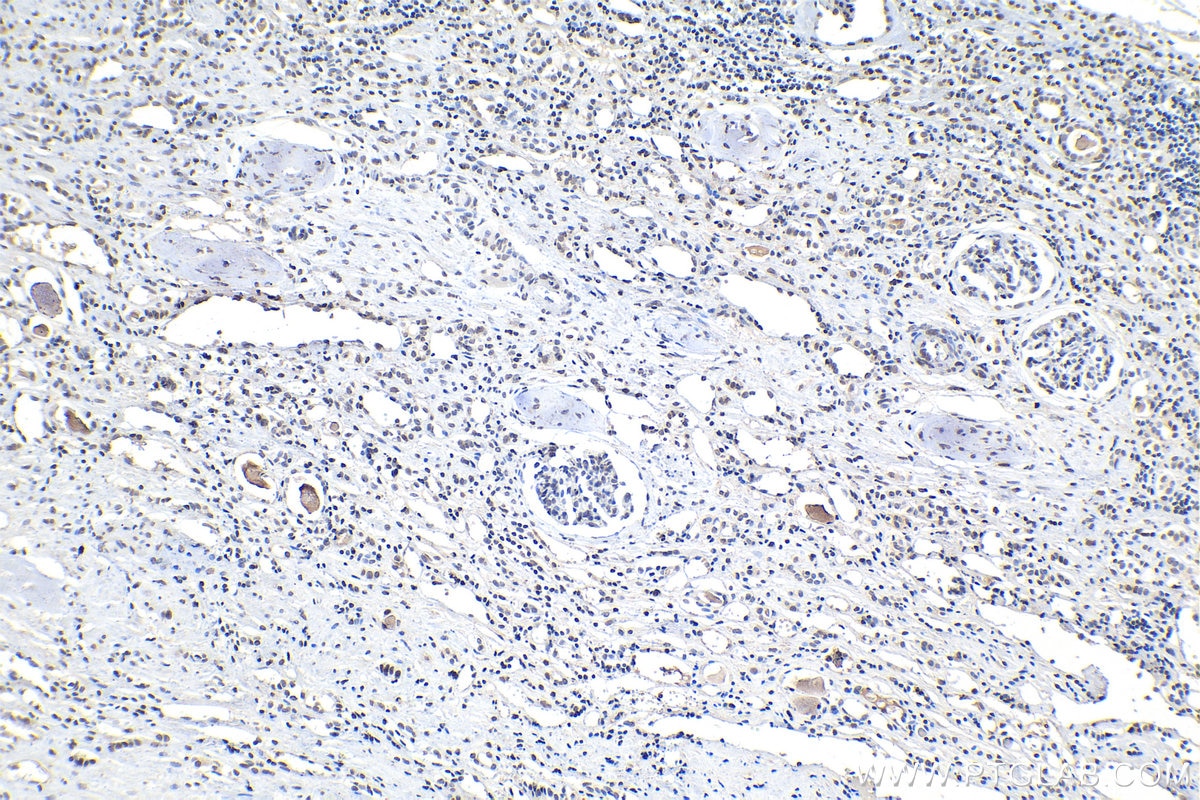 IHC staining of human renal cell carcinoma using 66863-1-Ig