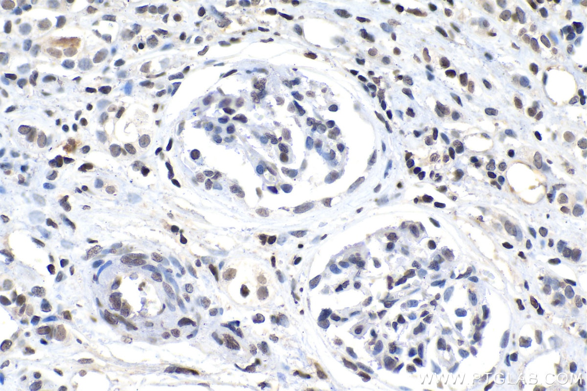 Immunohistochemistry (IHC) staining of human renal cell carcinoma tissue using Phospho-Histone H3 (Ser10) Monoclonal antibody (66863-1-Ig)