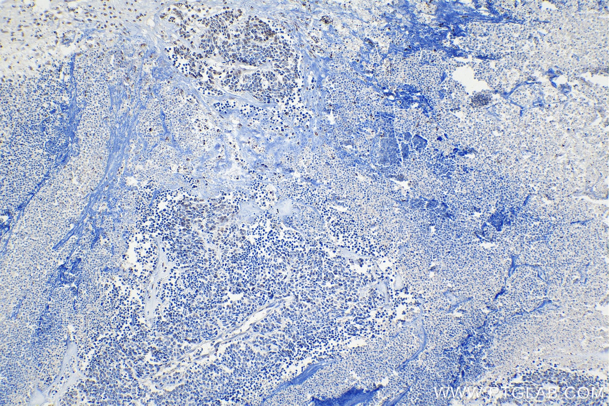 Immunohistochemistry (IHC) staining of human lung cancer tissue using Phospho-Histone H3 (Ser10) Monoclonal antibody (66863-1-Ig)