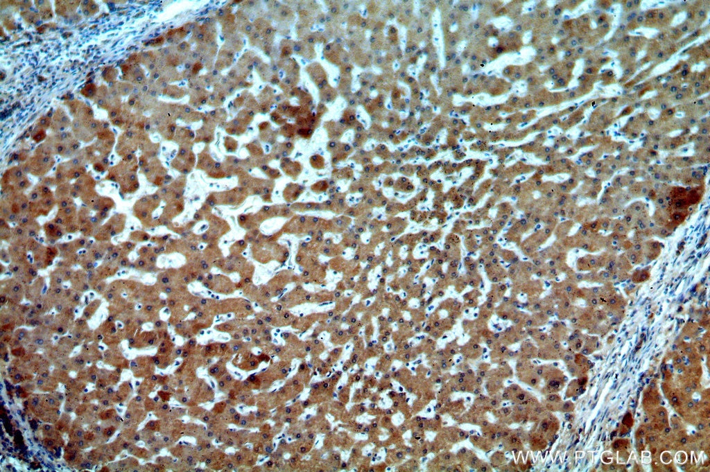 IHC staining of human hepatocirrhosis using 15255-1-AP