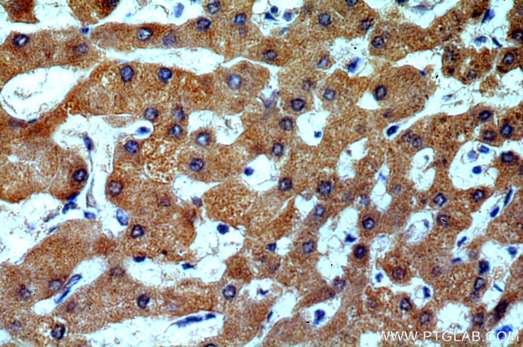 Immunohistochemistry (IHC) staining of human hepatocirrhosis tissue using H6PD Polyclonal antibody (15255-1-AP)