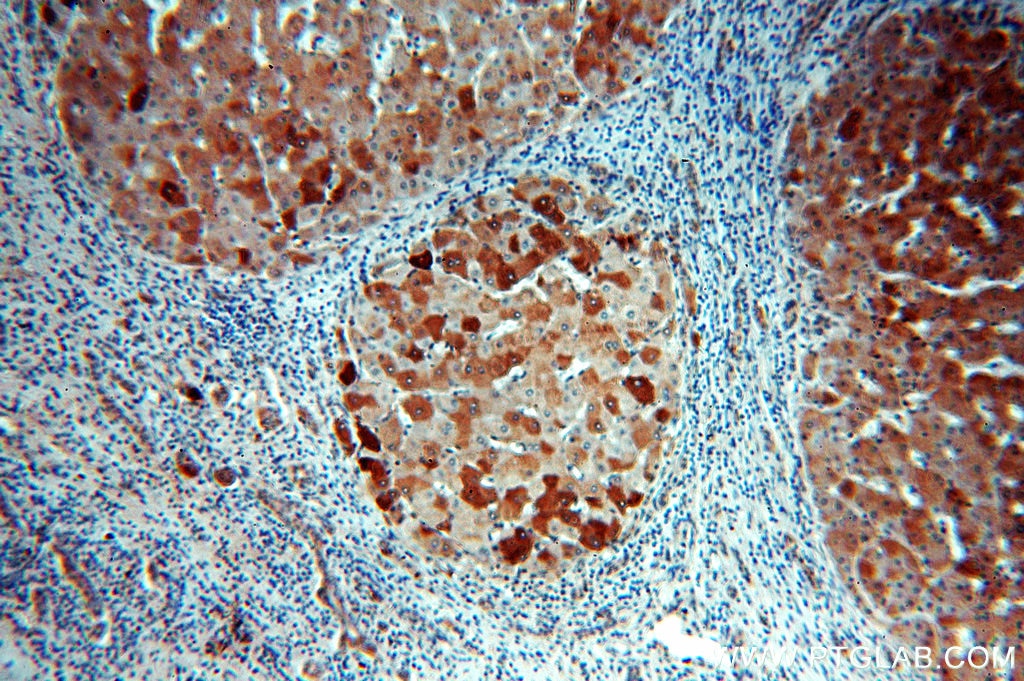 IHC staining of human hepatocirrhosis using 15255-1-AP