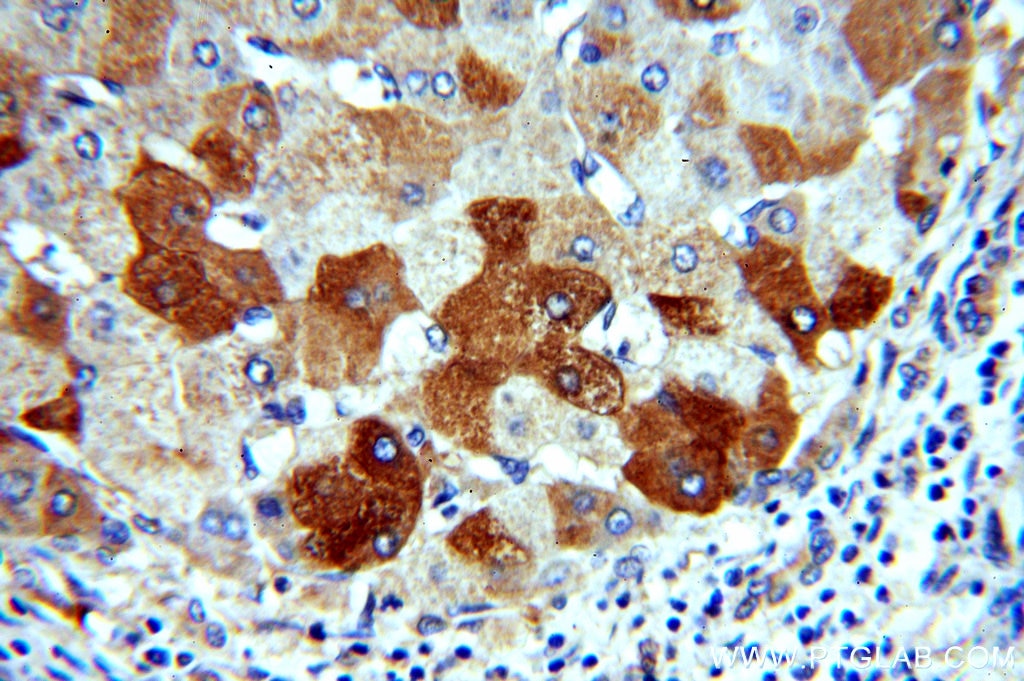 Immunohistochemistry (IHC) staining of human hepatocirrhosis tissue using H6PD Polyclonal antibody (15255-1-AP)