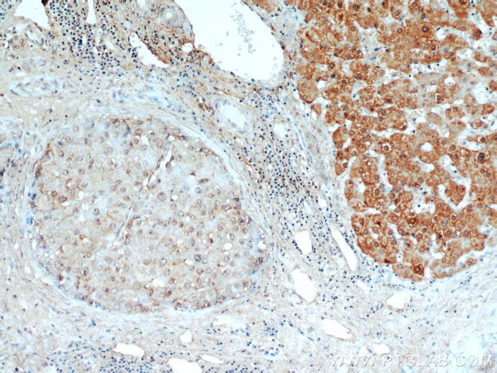 Immunohistochemistry (IHC) staining of human liver cancer tissue using H6PD Polyclonal antibody (15255-1-AP)