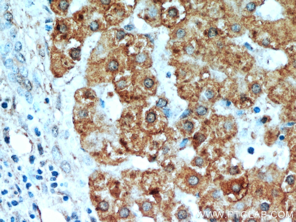 Immunohistochemistry (IHC) staining of human liver cancer tissue using H6PD Polyclonal antibody (15255-1-AP)