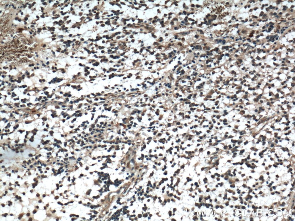 Immunohistochemistry (IHC) staining of human gliomas tissue using HAAO Polyclonal antibody (12791-1-AP)