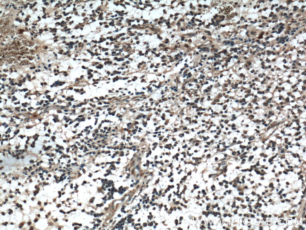 IHC staining of human gliomas using 12791-1-AP