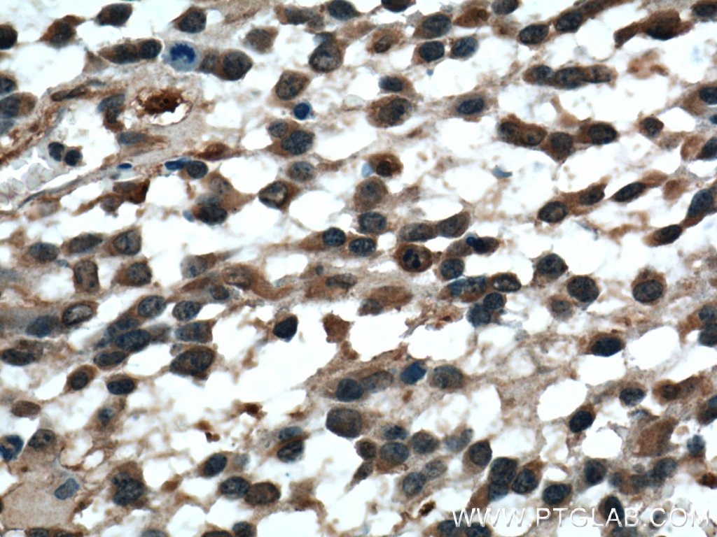 Immunohistochemistry (IHC) staining of human gliomas tissue using HAAO Polyclonal antibody (12791-1-AP)