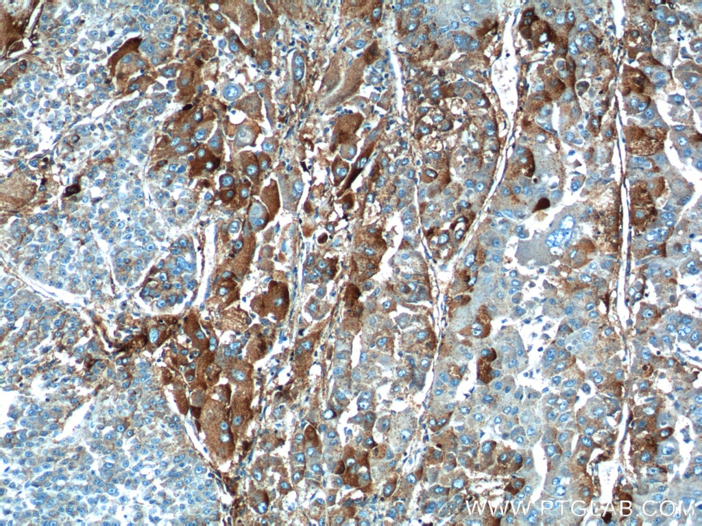 Immunohistochemistry (IHC) staining of human liver cancer tissue using HABP2 Polyclonal antibody (12863-1-AP)
