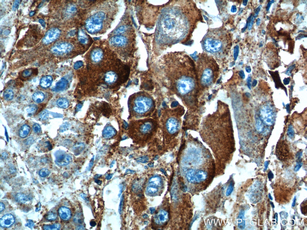 Immunohistochemistry (IHC) staining of human liver cancer tissue using HABP2 Polyclonal antibody (12863-1-AP)