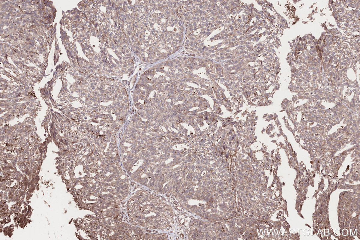 Immunohistochemistry (IHC) staining of human ovary cancer tissue using HACE1 Polyclonal antibody (24104-1-AP)