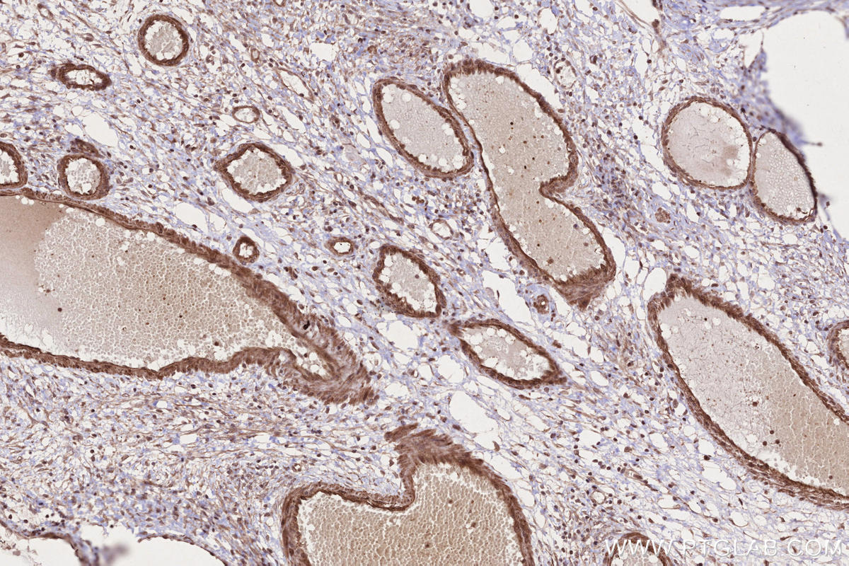Immunohistochemistry (IHC) staining of human ovary cancer tissue using HACE1 Polyclonal antibody (24104-1-AP)