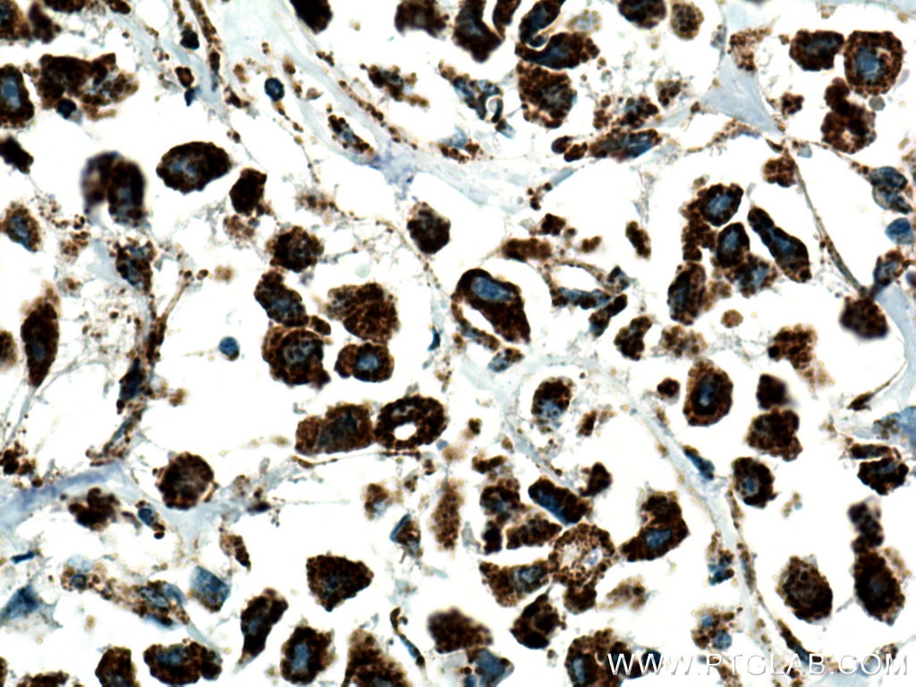 Immunohistochemistry (IHC) staining of human breast cancer tissue using HADH Polyclonal antibody (19828-1-AP)