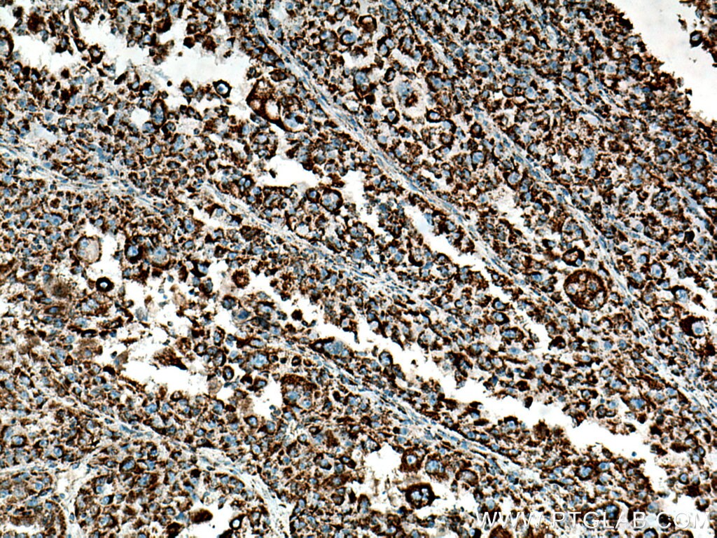 Immunohistochemistry (IHC) staining of human liver cancer tissue using HADH Polyclonal antibody (19828-1-AP)