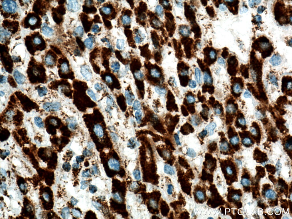 Immunohistochemistry (IHC) staining of human liver cancer tissue using HADH Polyclonal antibody (19828-1-AP)