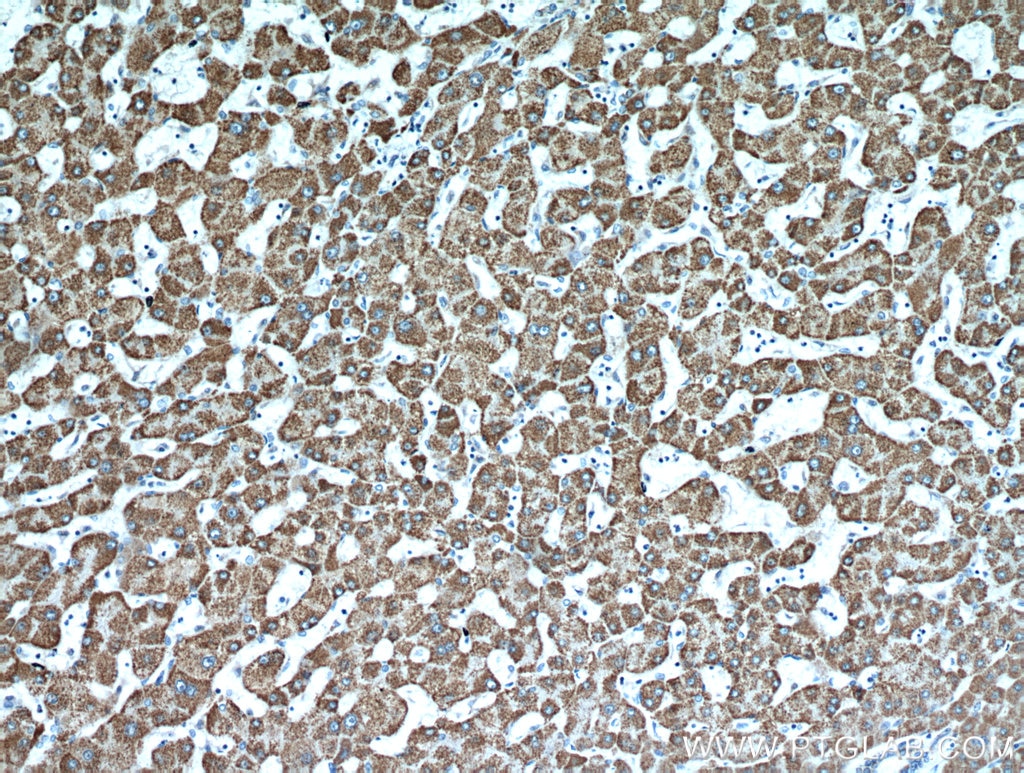 Immunohistochemistry (IHC) staining of human hepatocirrhosis tissue using HADH Polyclonal antibody (19828-1-AP)