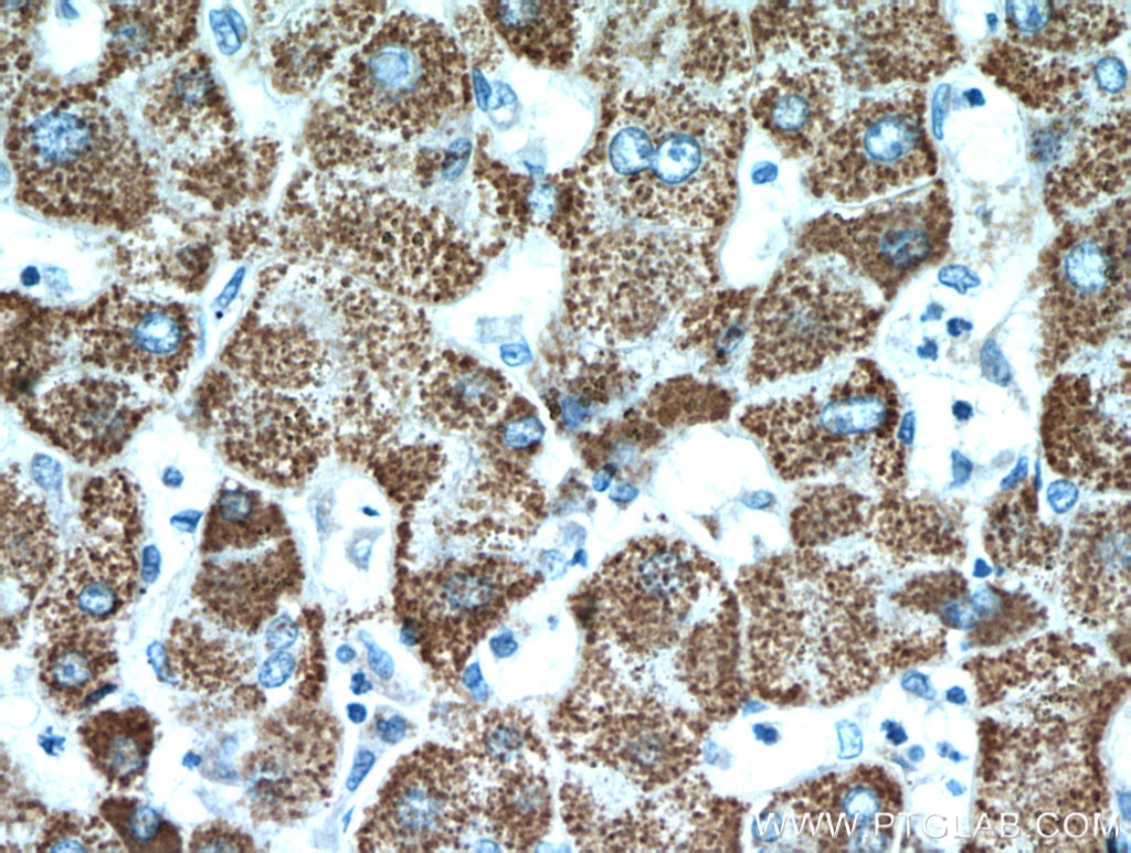 IHC staining of human hepatocirrhosis using 19828-1-AP