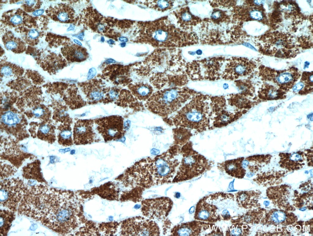 IHC staining of human hepatocirrhosis using 19828-1-AP