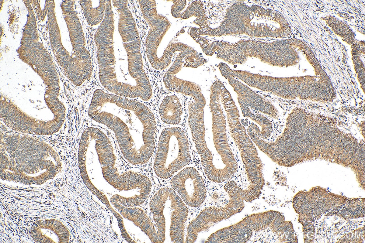 Immunohistochemistry (IHC) staining of human colon cancer tissue using HADHA Polyclonal antibody (10758-1-AP)