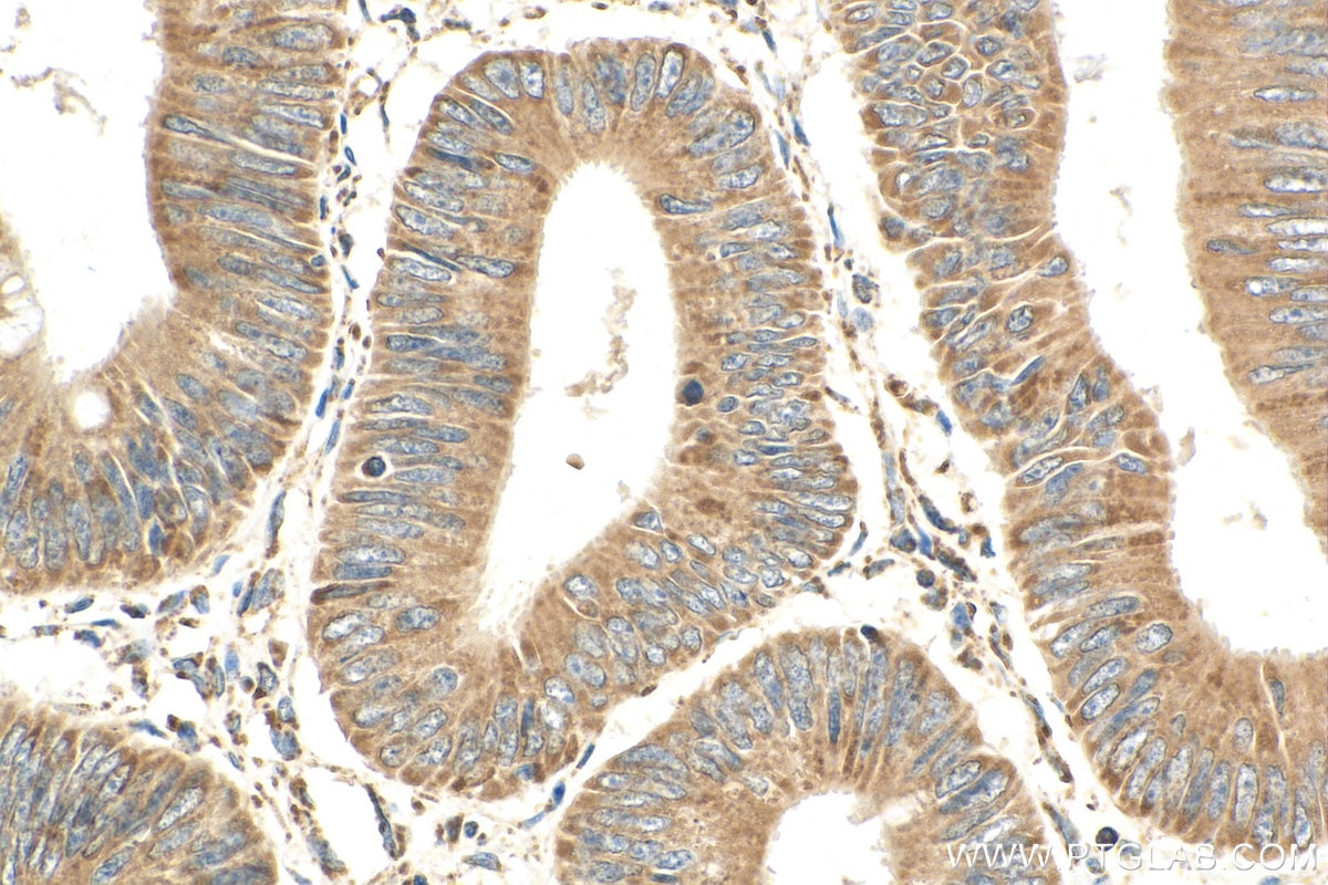 Immunohistochemistry (IHC) staining of human colon cancer tissue using HADHA Polyclonal antibody (10758-1-AP)