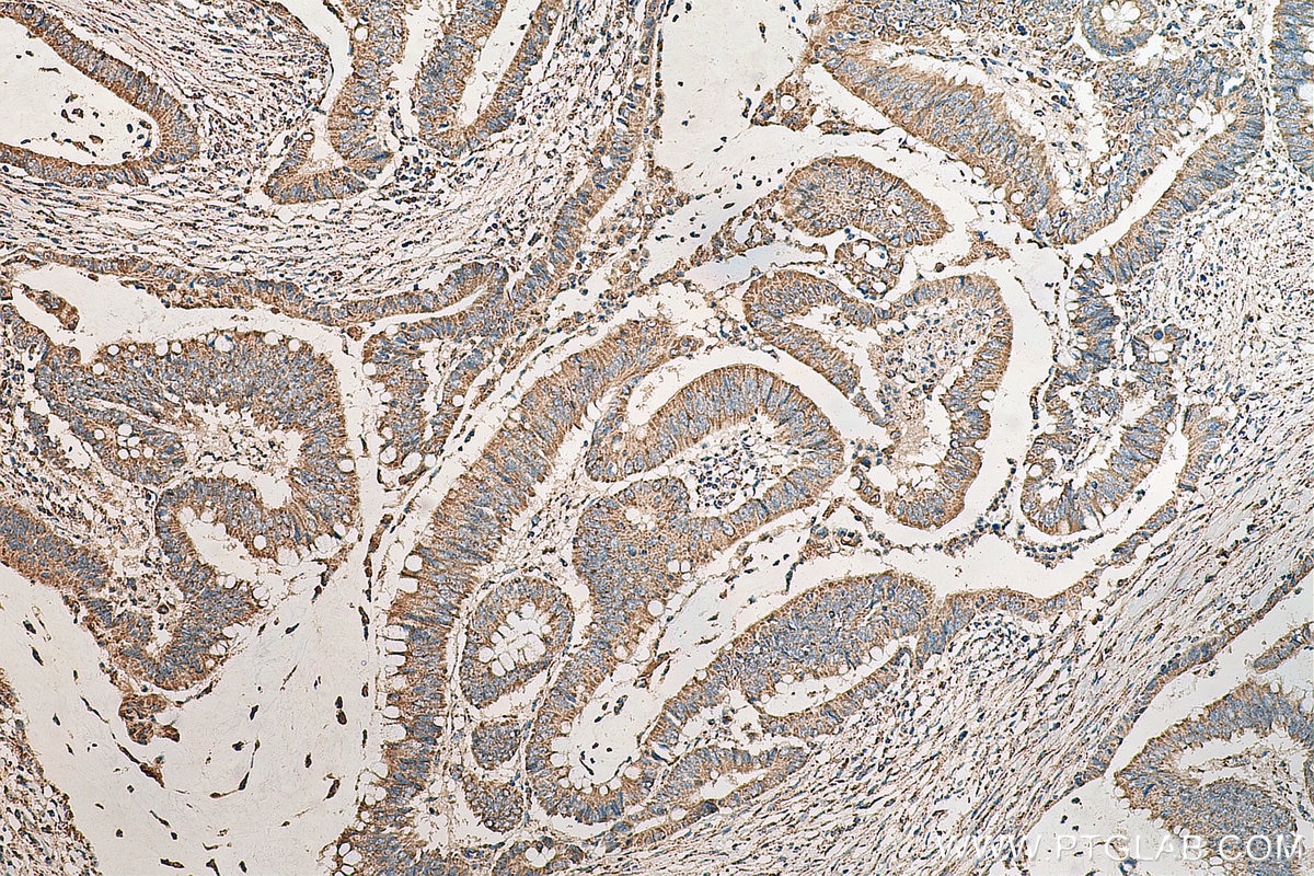 Immunohistochemistry (IHC) staining of human colon cancer tissue using HADHB Polyclonal antibody (29091-1-AP)