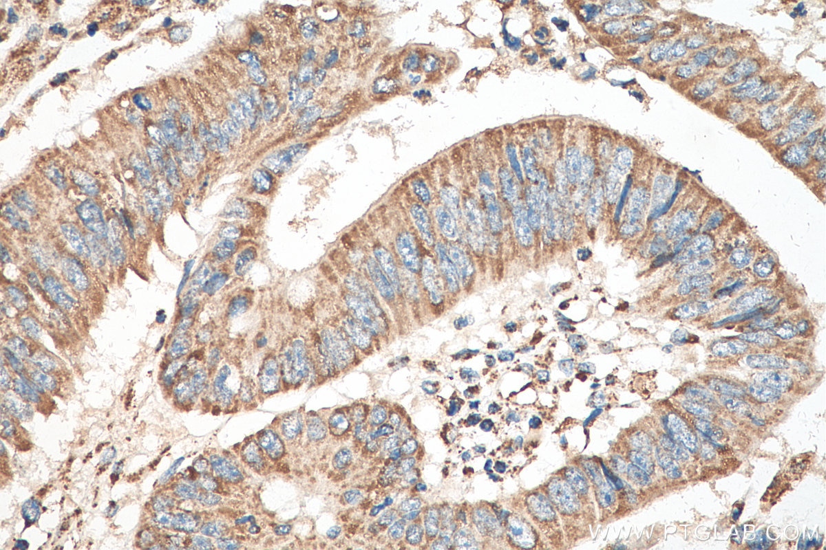 Immunohistochemistry (IHC) staining of human colon cancer tissue using HADHB Polyclonal antibody (29091-1-AP)