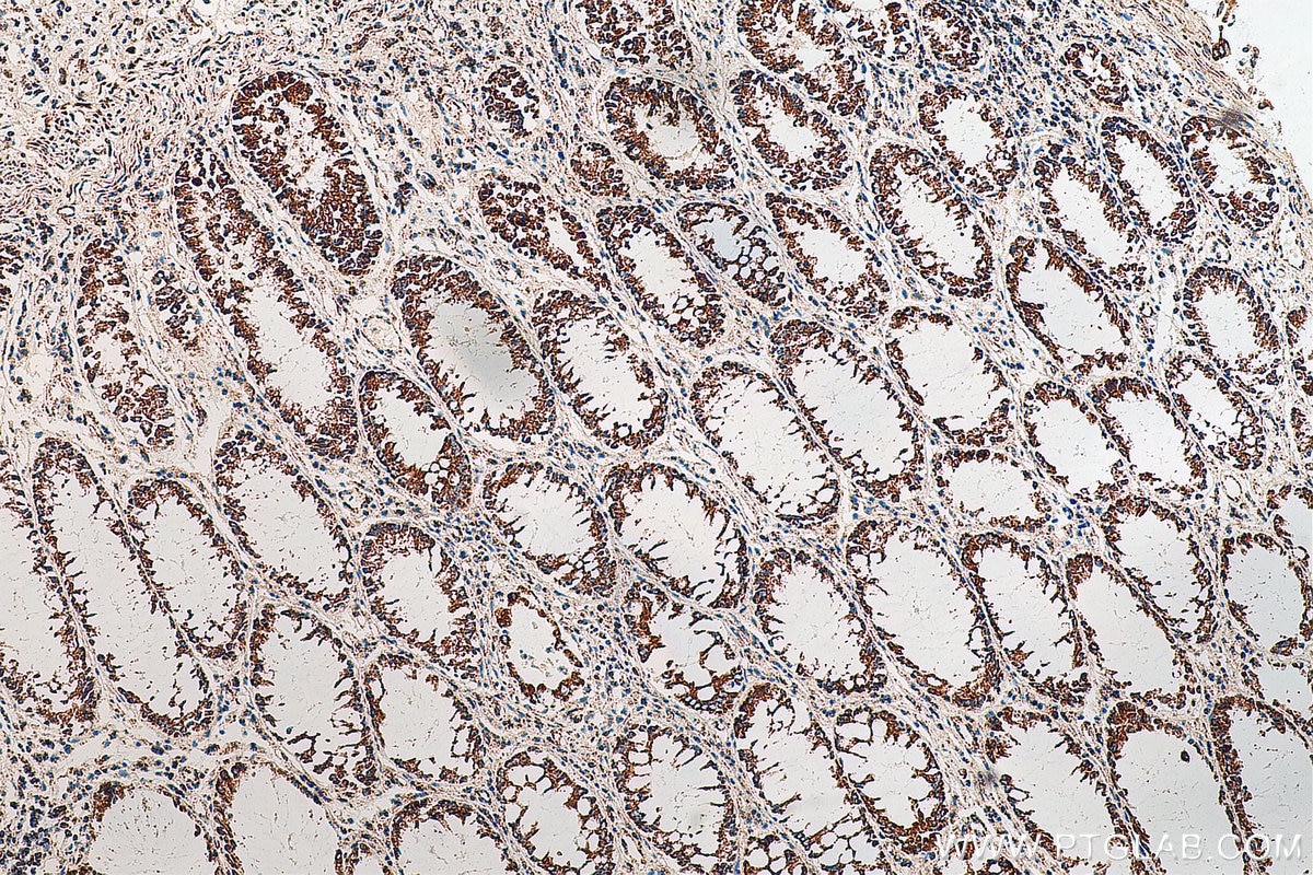 IHC staining of human colon cancer using 67967-1-Ig