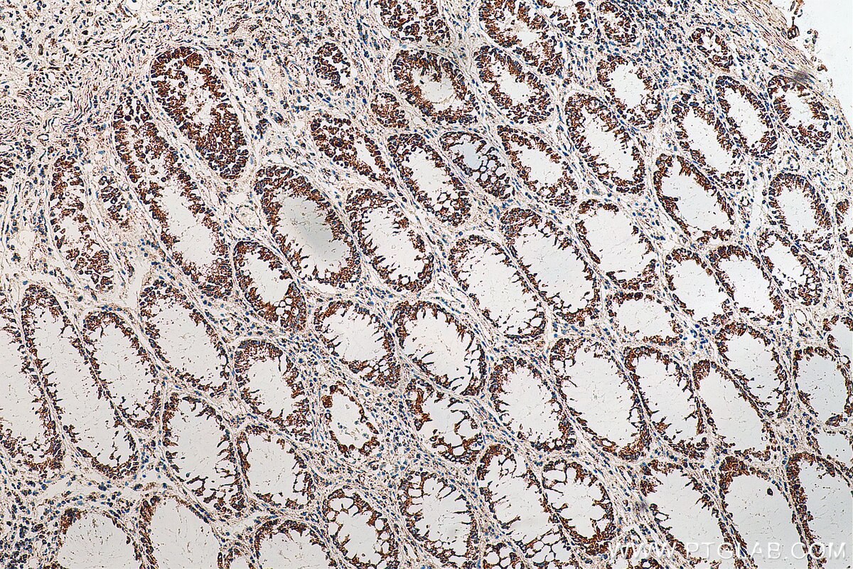 Immunohistochemistry (IHC) staining of human colon cancer tissue using HADHB Monoclonal antibody (67967-1-Ig)