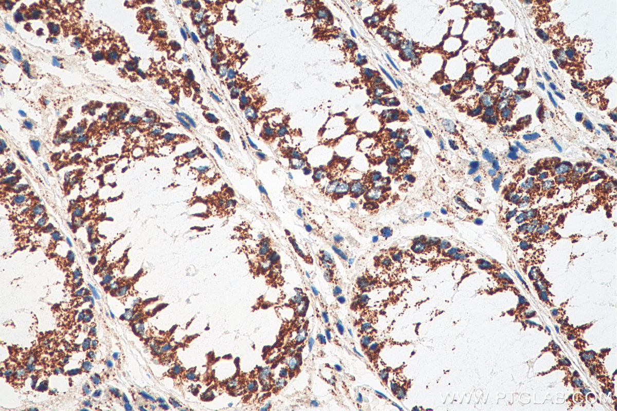Immunohistochemistry (IHC) staining of human colon cancer tissue using HADHB Monoclonal antibody (67967-1-Ig)