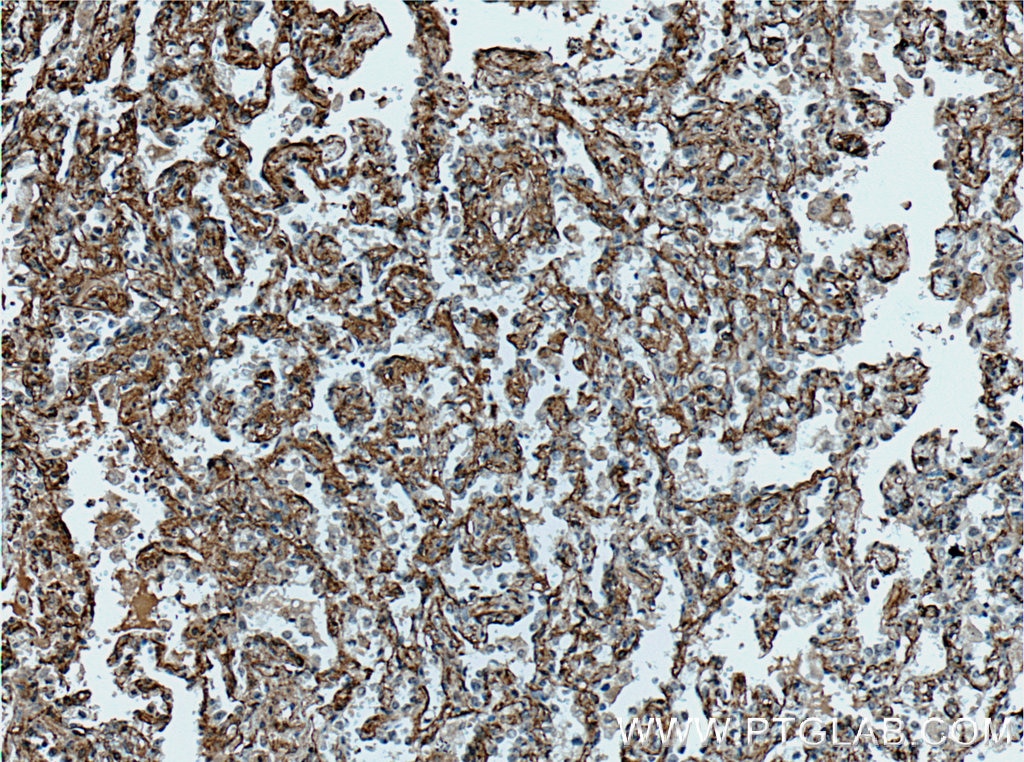 Immunohistochemistry (IHC) staining of human lung cancer tissue using HAI-1 Polyclonal antibody (27593-1-AP)