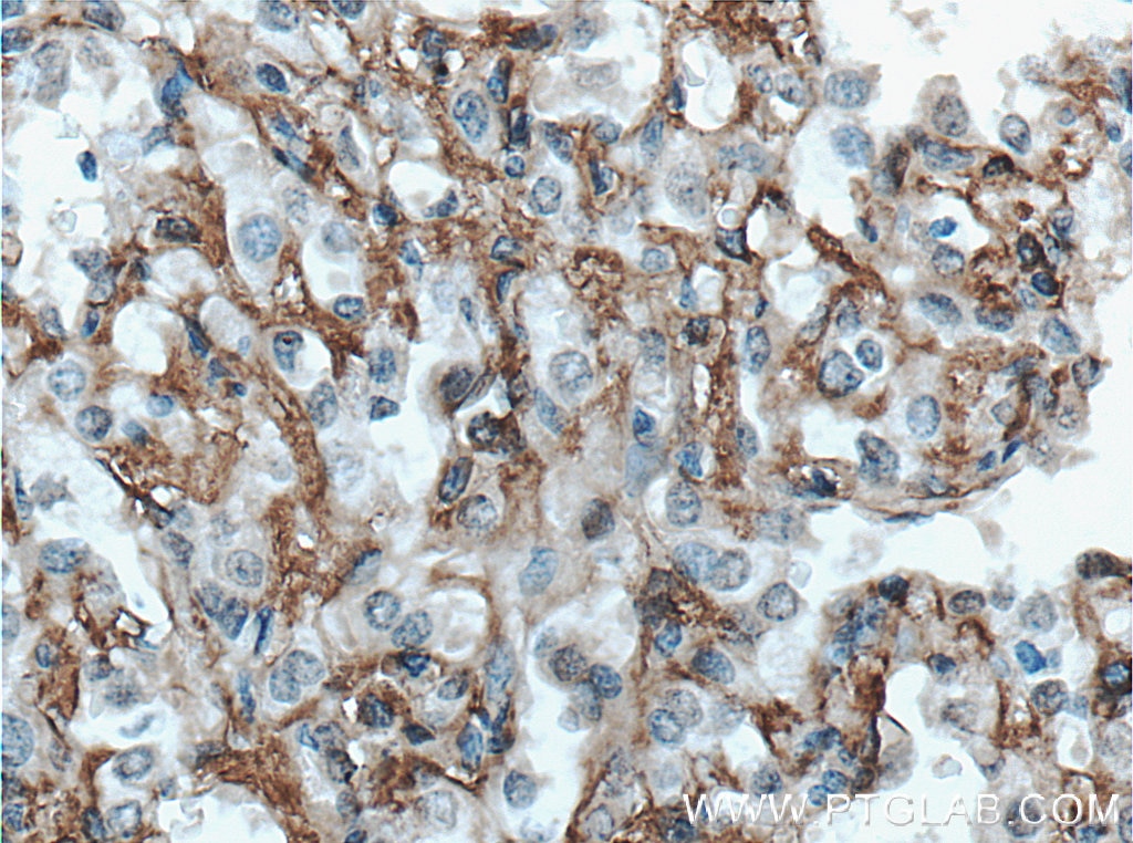 Immunohistochemistry (IHC) staining of human lung cancer tissue using HAI-1 Polyclonal antibody (27593-1-AP)