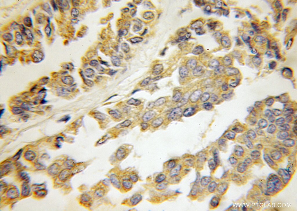 Immunohistochemistry (IHC) staining of human breast cancer tissue using HARS2 Polyclonal antibody (11301-1-AP)