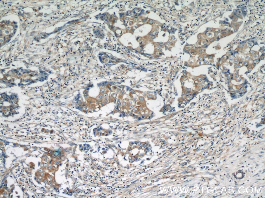 Immunohistochemistry (IHC) staining of human breast cancer tissue using HARS2 Polyclonal antibody (11301-1-AP)
