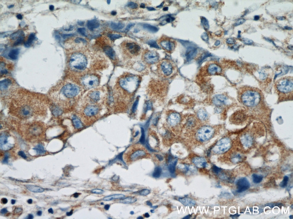 IHC staining of human breast cancer using 11301-1-AP