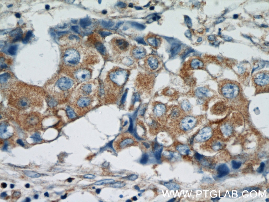 Immunohistochemistry (IHC) staining of human breast cancer tissue using HARS2 Polyclonal antibody (11301-1-AP)