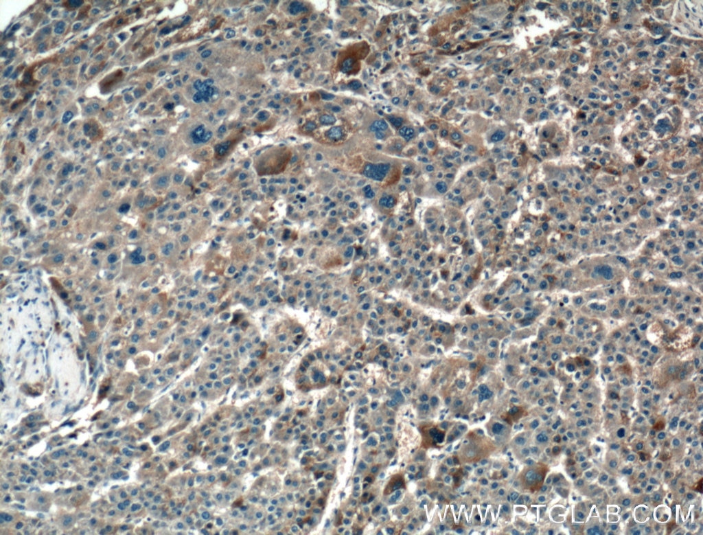 Immunohistochemistry (IHC) staining of human liver cancer tissue using HAS3 Polyclonal antibody (15609-1-AP)